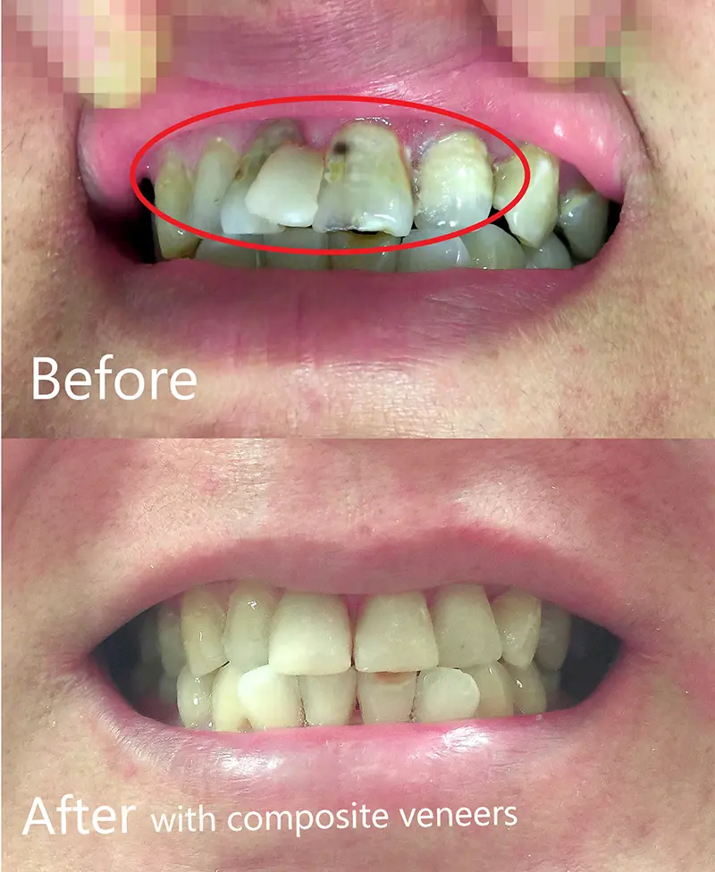Composite Restorations & Cavity Treatment 1